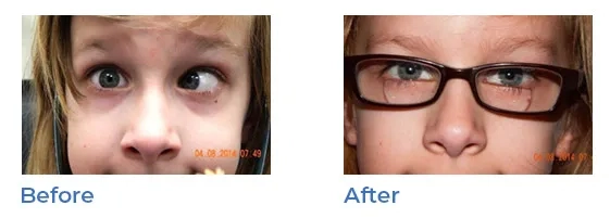 strabismus - before and after 01