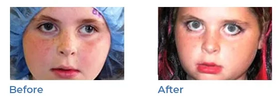 strabismus - before and after 04